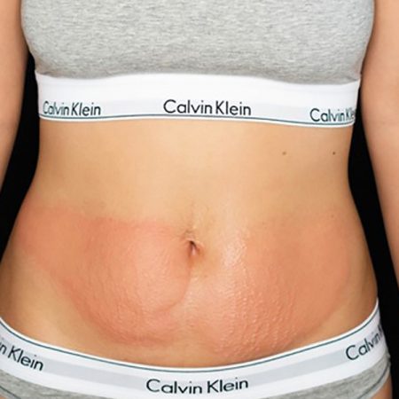 CryoSlimming after 5 treatments