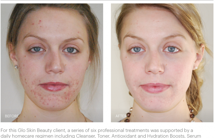 Glo Skin Beauty Transformation2